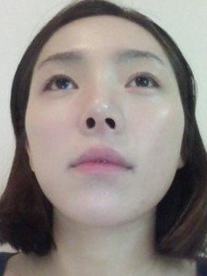 長(zhǎng)春中妍整形醫(yī)院吳學(xué)軍醫(yī)生做玻尿酸墊下巴+玻尿酸豐太陽(yáng)穴案例效果對(duì)比圖 長(zhǎng)春中妍整形醫(yī)院吳學(xué)軍醫(yī)生做玻尿酸墊下巴+玻尿酸豐太陽(yáng)穴案例效果對(duì)比圖