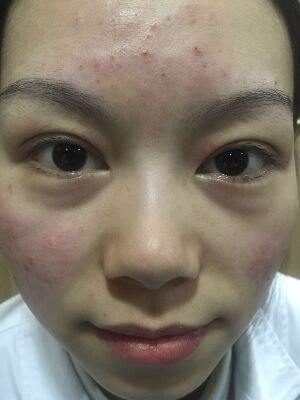 西安壹加壹整形醫(yī)院劉晨醫(yī)生做點陣激光祛痘效果怎么樣？附點陣激光祛痘效果圖