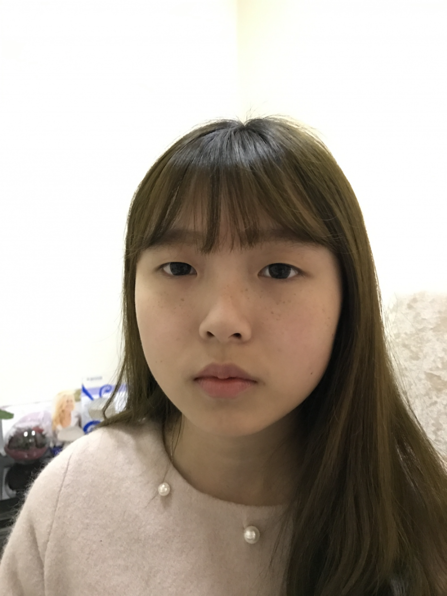 西安米蘭柏羽整形醫(yī)院李旭平做雙眼皮+開眼角技術怎么樣？附醫(yī)院案例