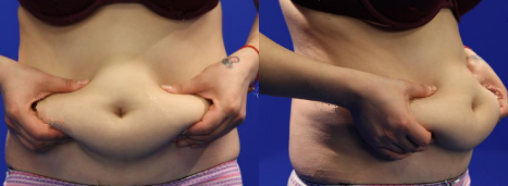廣州韓佳人整形醫(yī)院詹曉芳做腹部吸脂效果怎么樣？附案例效果對(duì)比圖
