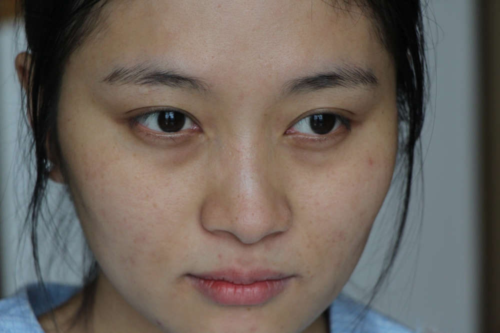 哈爾濱禾力康整形醫(yī)院劉亞春醫(yī)生做點(diǎn)陣激光去痘印效果怎么樣？附案例