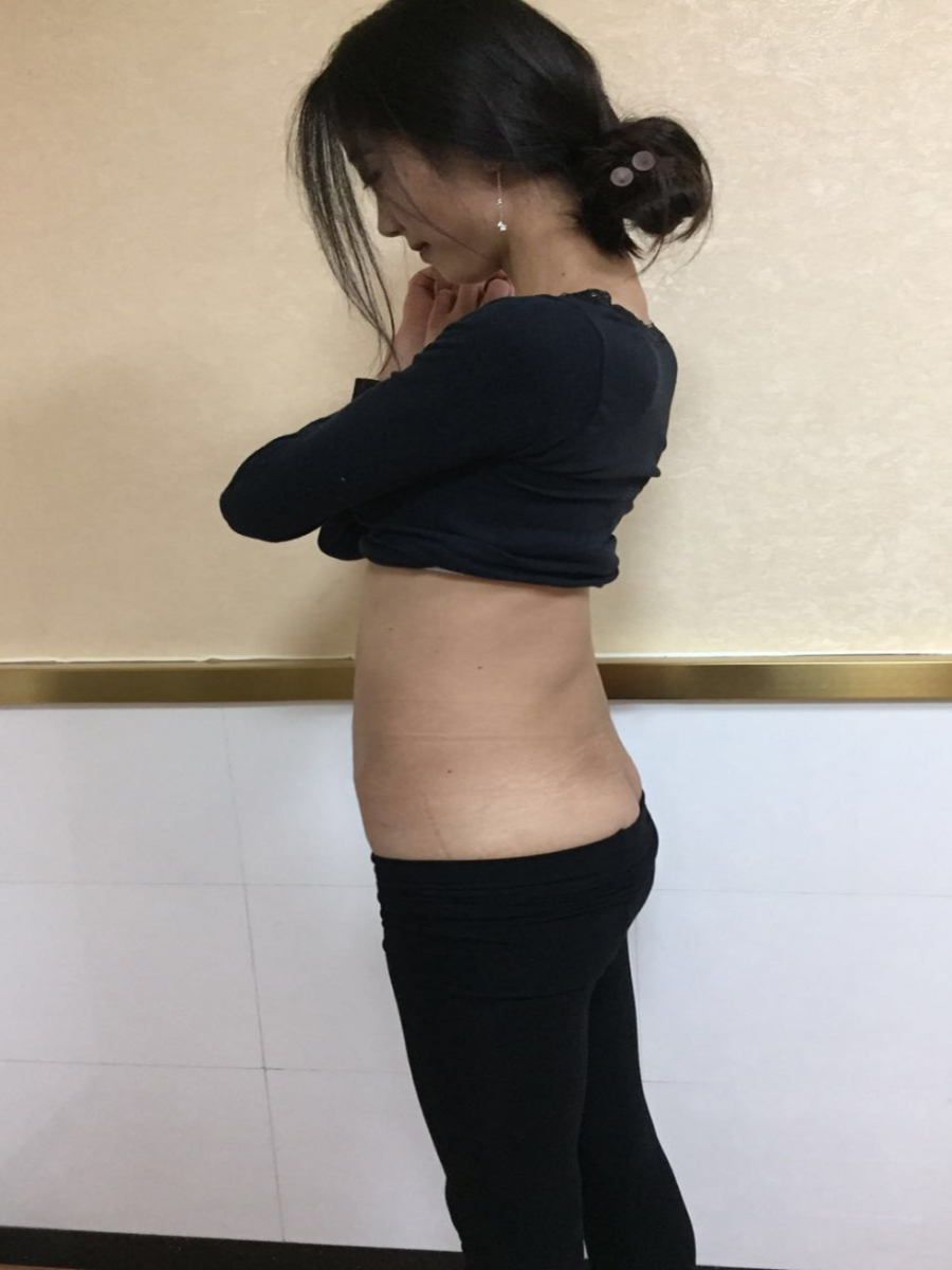 北京東方瑞麗整形醫(yī)生夏兆驥做腰腹吸脂效果怎么樣？附腰腹吸脂案例效果對(duì)比圖