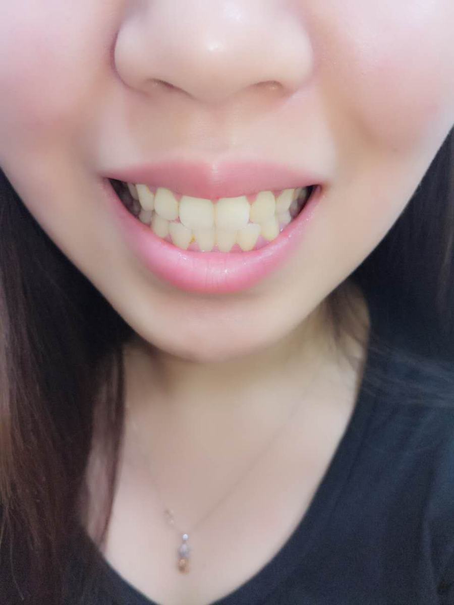 杭州國雅口腔醫(yī)院張虹醫(yī)生做冷光美白效果怎么樣？附冷光美白案例效果對比圖