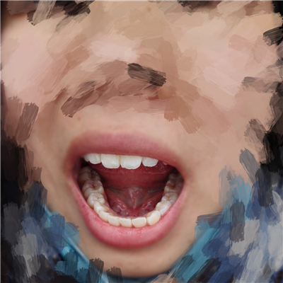 重慶華西牙科醫(yī)院童冠雄超聲波洗牙怎么樣？附超聲波洗牙案例對比圖