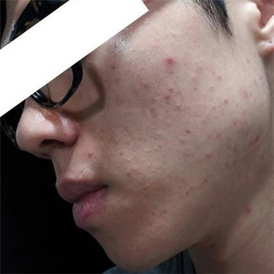 浙江綠城醫(yī)院整形美容中心丁路醫(yī)生做激光祛痘效果怎么樣，附案例對比圖