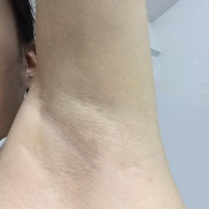 廈門張銘整醫(yī)療整形醫(yī)生張小玲做激光脫腋毛怎么樣？附激光脫腋毛效果對(duì)比圖