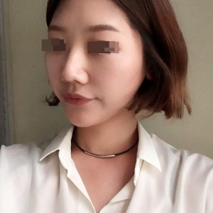 太原麗都整形醫(yī)院劉晉艷醫(yī)生做光纖溶脂瘦臉怎么樣？附案例效果對(duì)比圖