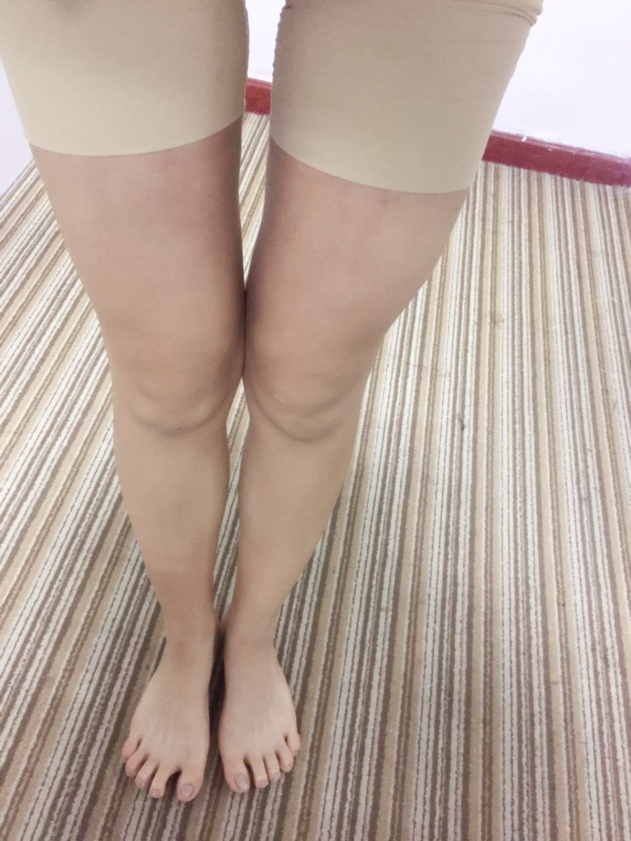 北京蒂凡妮整形靳玉彪醫(yī)生做大腿吸脂怎么樣？附大腿吸脂案例效果對比圖