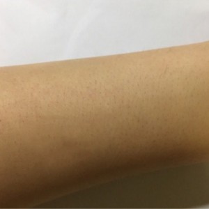 鄭州屈小麗醫(yī)療整形醫(yī)院醫(yī)生劉丹做手臂脫毛怎么樣？附手臂脫毛案例