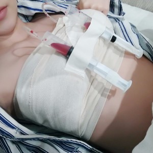 廣州廣大整形美容醫(yī)院醫(yī)生查旭山做假體隆胸怎么樣？附案例