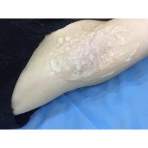 廈門張銘整醫(yī)療整形醫(yī)生張小玲做激光脫腋毛怎么樣？附激光脫腋毛效果對比圖