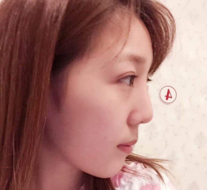 鄭州致美士整形醫(yī)院醫(yī)生閆江濤做鼻綜合+自體脂肪填充+吸脂案例效果對比圖