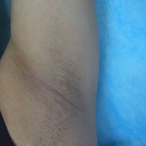 廈門張銘整醫(yī)療整形醫(yī)生張小玲做激光脫腋毛怎么樣？附激光脫腋毛效果對比圖