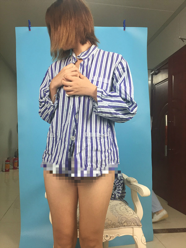 北京蒂凡妮整形靳玉彪醫(yī)生做大腿吸脂怎么樣？附大腿吸脂案例效果對比圖