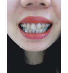 安徽天鵝湖口腔醫(yī)院張永莉醫(yī)生做牙齒矯正怎么樣？附牙齒矯正案例效果對(duì)比圖