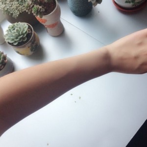 鄭州屈小麗醫(yī)療整形醫(yī)院醫(yī)生劉丹做手臂脫毛怎么樣？附手臂脫毛案例