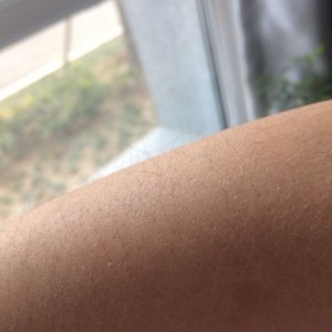 鄭州屈小麗醫(yī)療整形醫(yī)院醫(yī)生劉丹做手臂脫毛怎么樣？附手臂脫毛案例