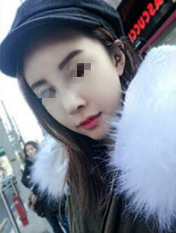 天津時光整形醫(yī)生盧丙侖做駝峰鼻怎么樣？附案例效果對比圖