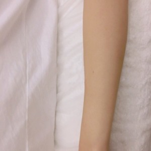 鄭州屈小麗醫(yī)療整形醫(yī)院醫(yī)生劉丹做手臂脫毛怎么樣？附手臂脫毛案例