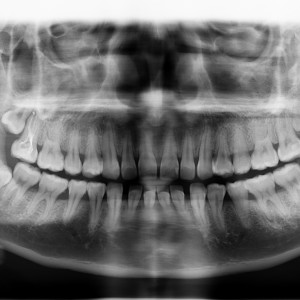 廈門拜博口腔醫(yī)院醫(yī)生張忠做牙齒隱形矯正怎么樣？附案例效果對比圖