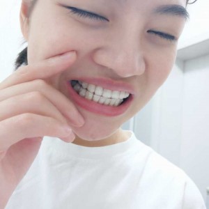 廈門拜博口腔醫(yī)院醫(yī)生張忠做牙齒隱形矯正怎么樣？附案例效果對比圖