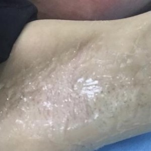 廈門張銘整醫(yī)療整形醫(yī)生張小玲做激光脫腋毛怎么樣？附激光脫腋毛效果對比圖