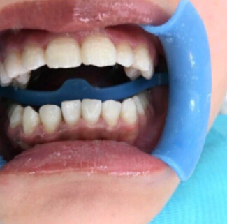 洛陽友好口腔醫(yī)院醫(yī)生楊愛芳做牙齒冷光美白怎么樣？附案例效果圖