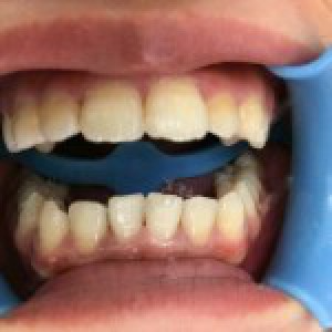 洛陽(yáng)友好口腔醫(yī)院醫(yī)生楊愛芳做牙齒冷光美白怎么樣？附案例效果圖