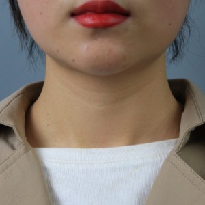 上海名媛醫(yī)療整形醫(yī)生閆嬌君做嗨體去頸紋效果怎么樣？附案例效果圖