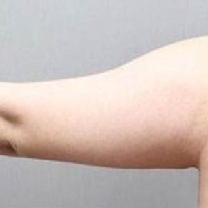 岳陽愛思特醫(yī)療美容醫(yī)院醫(yī)生王福生做手臂吸脂怎么樣？附案例效果圖