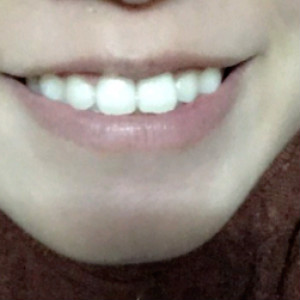 洛陽(yáng)友好口腔醫(yī)院醫(yī)生楊愛芳做牙齒冷光美白怎么樣？附案例效果圖