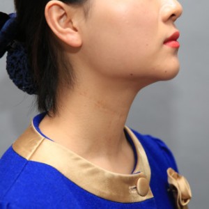 上海名媛醫(yī)療整形醫(yī)生閆嬌君做嗨體去頸紋效果怎么樣？附案例效果圖