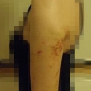 岳陽愛思特醫(yī)療美容醫(yī)院醫(yī)生王福生做手臂吸脂怎么樣？附案例效果圖