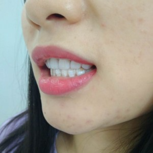 洛陽友好口腔醫(yī)院醫(yī)生李新然做牙貼面怎么樣？附案例效果圖