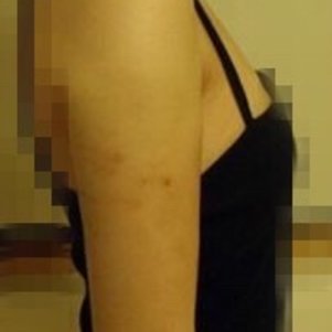 岳陽愛思特醫(yī)療美容醫(yī)院醫(yī)生王福生做手臂吸脂怎么樣？附案例效果圖