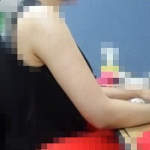 岳陽愛思特醫(yī)療美容醫(yī)院醫(yī)生王福生做手臂吸脂怎么樣？附案例效果圖