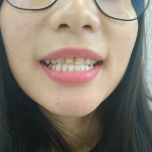 洛陽(yáng)友好口腔醫(yī)院醫(yī)生李新然做牙貼面怎么樣？附案例效果圖