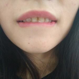 黔西南興義京州口腔醫(yī)院醫(yī)生徐勇做牙貼面怎么樣？附案例效果對(duì)比圖