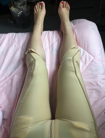 上海保加醫(yī)療美容門診部做大腿吸脂怎么樣？附楊勇醫(yī)生案例效果對比圖