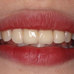 上海科瓦口腔醫(yī)院醫(yī)生鄧建儒做牙齒冷光美白怎么樣？附案例效果對比圖