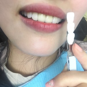 上海科瓦口腔醫(yī)院醫(yī)生鄧建儒做牙齒冷光美白怎么樣？附案例效果對比圖