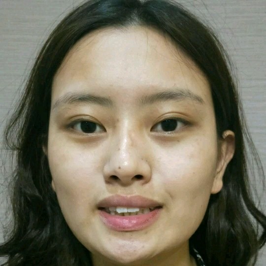 廣州愛(ài)來(lái)整形醫(yī)院醫(yī)生肖大衛(wèi)做激光點(diǎn)痣怎么樣？附案例效果對(duì)比圖