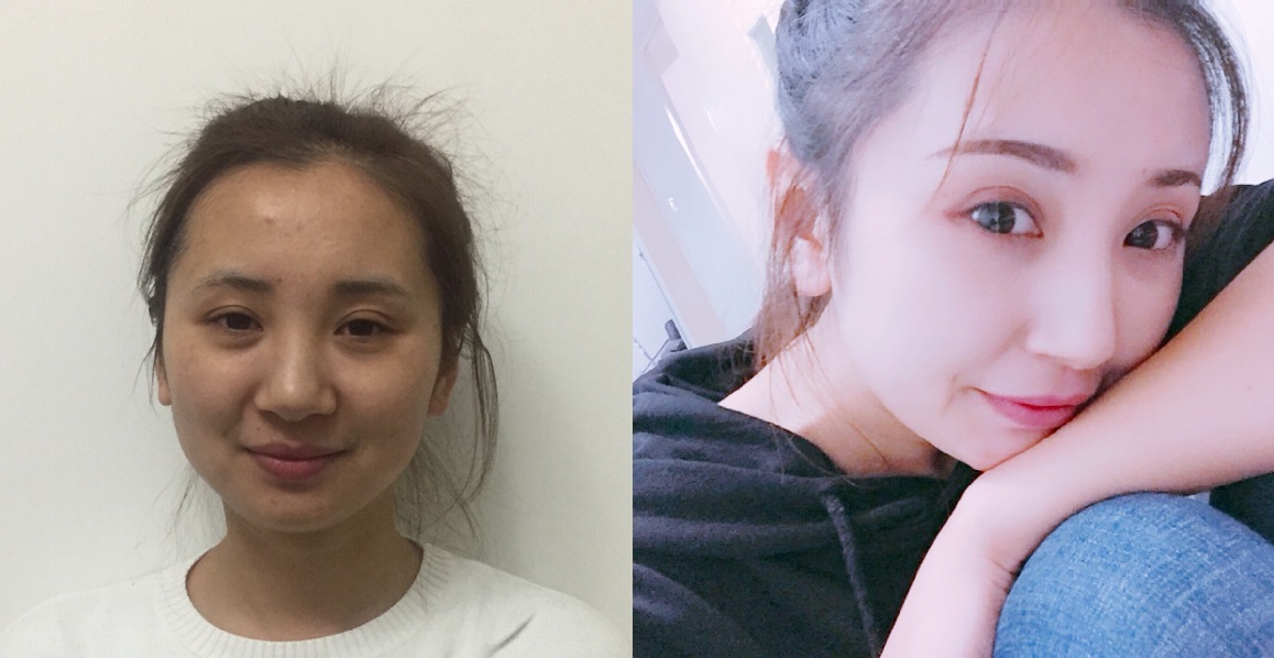 貴陽藝齡醫(yī)療美容門診部醫(yī)生李章做隆鼻手術(shù)怎么樣？附案例效果對比圖