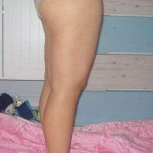 長沙真愛整形美容醫(yī)院醫(yī)生陳詠玲做大腿吸脂效果怎么樣？