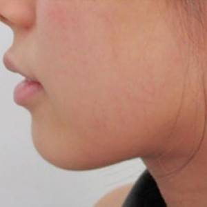 蚌埠韓美美萊整形醫(yī)院醫(yī)生張濤做玻尿酸墊下巴怎么樣？來看案例效果圖