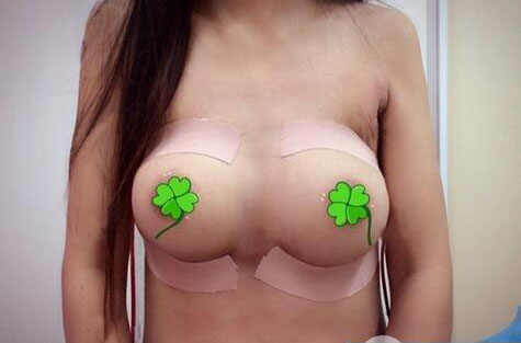 海南伊佳醫(yī)療美容醫(yī)院醫(yī)生涂陽君做假體隆胸怎么樣？附案例效果對(duì)比圖