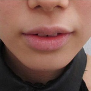 蚌埠韓美美萊整形醫(yī)院醫(yī)生張濤做玻尿酸墊下巴怎么樣？來看案例效果圖