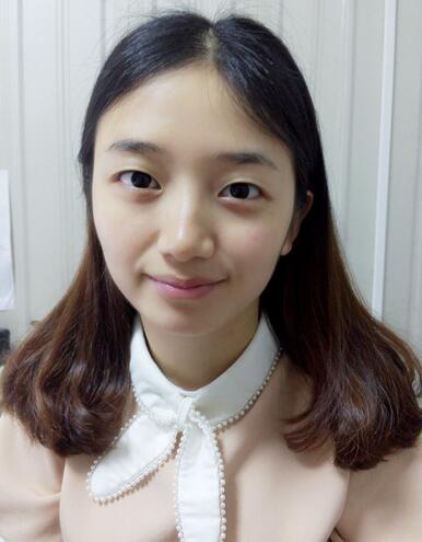 長治松禾醫(yī)療美容診所醫(yī)生馬俊峰做韓式微創(chuàng)定點雙眼皮效果怎么樣？附案例