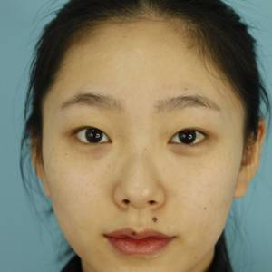 鄭州安格潤(rùn)整形醫(yī)生楊曉紅做雙眼皮手術(shù)怎么樣？附案例效果圖