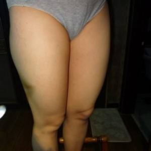 長(zhǎng)沙真愛整形美容醫(yī)院醫(yī)生陳詠玲做大腿吸脂效果怎么樣？